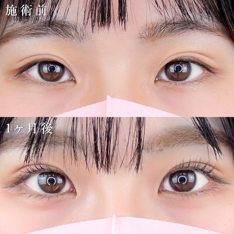 二重埋没法(担当医:TCB 医師)の症例写真1
