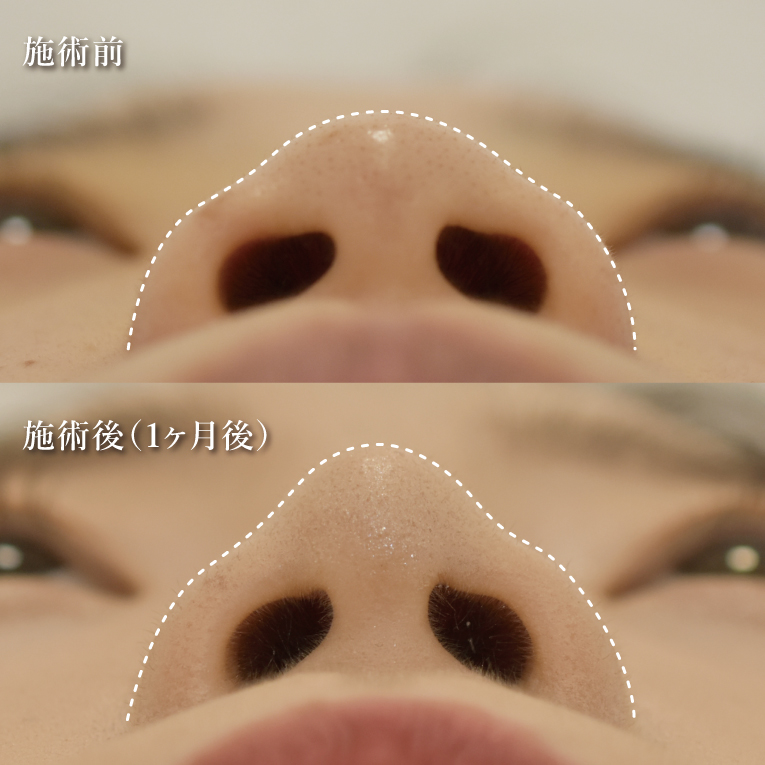 鼻プロテーゼ（隆鼻術）(担当医:TCB 医師)の症例写真2