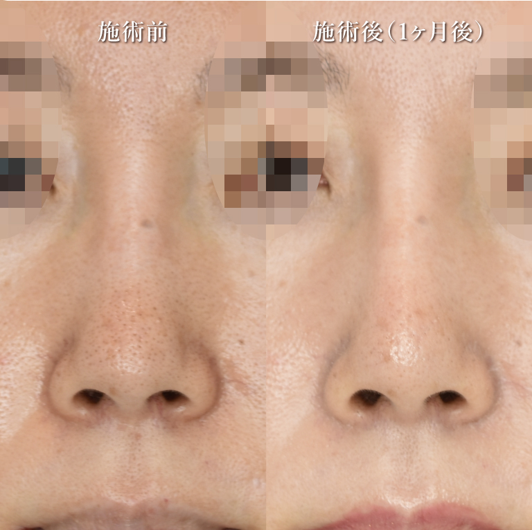 鼻プロテーゼ（隆鼻術）(担当医:村田 将光 医師)の症例写真2