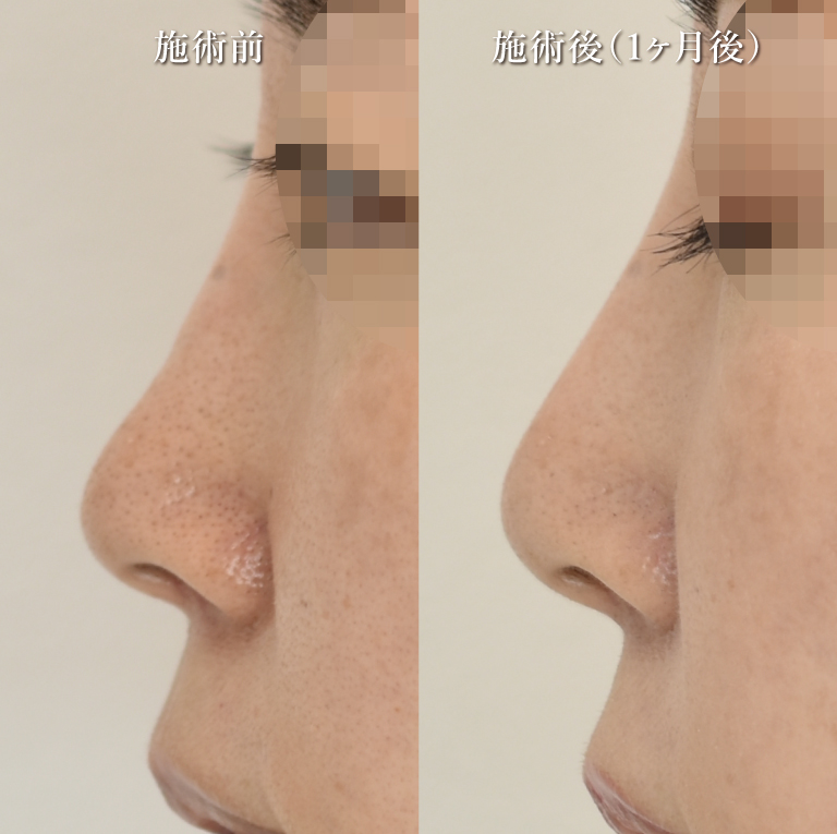 鼻プロテーゼ（隆鼻術）(担当医:村田 将光 医師)の症例写真1