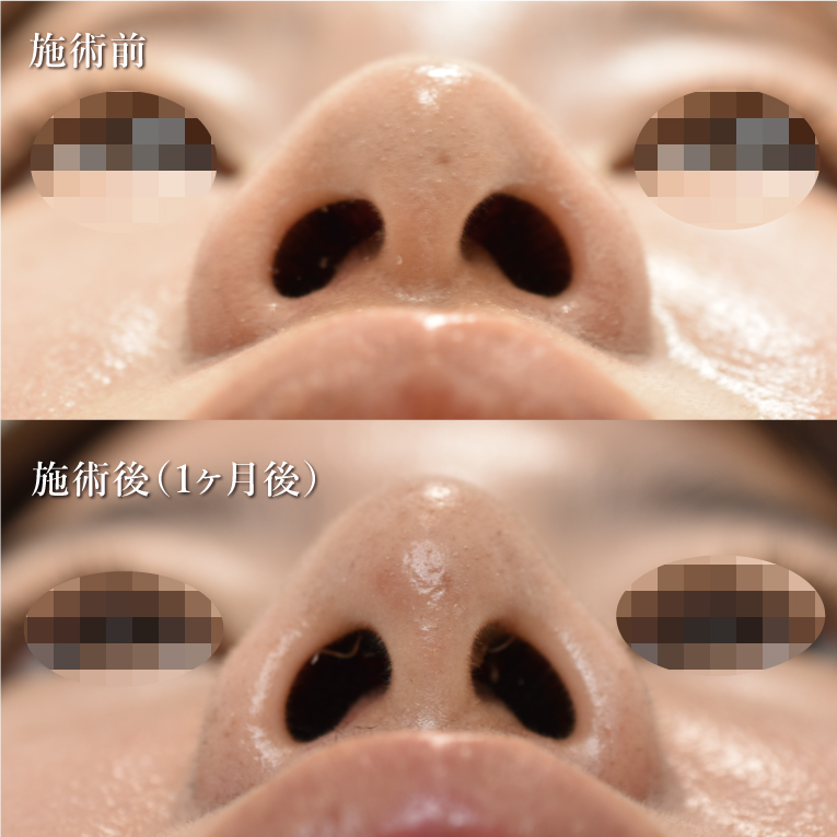 鼻尖形成(担当医:村田 将光 医師)の症例写真1