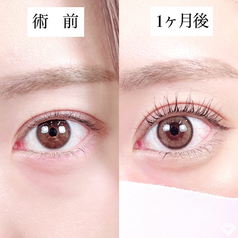 二重埋没法(担当医:TCB 医師)の症例写真1