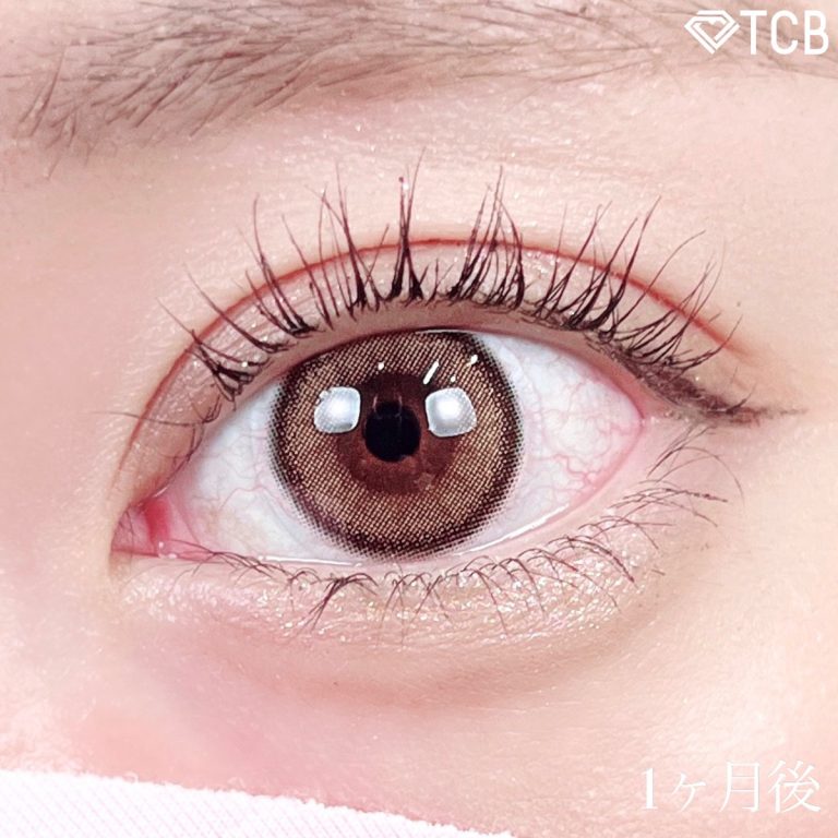 二重埋没法(担当医:TCB 医師)の症例写真2