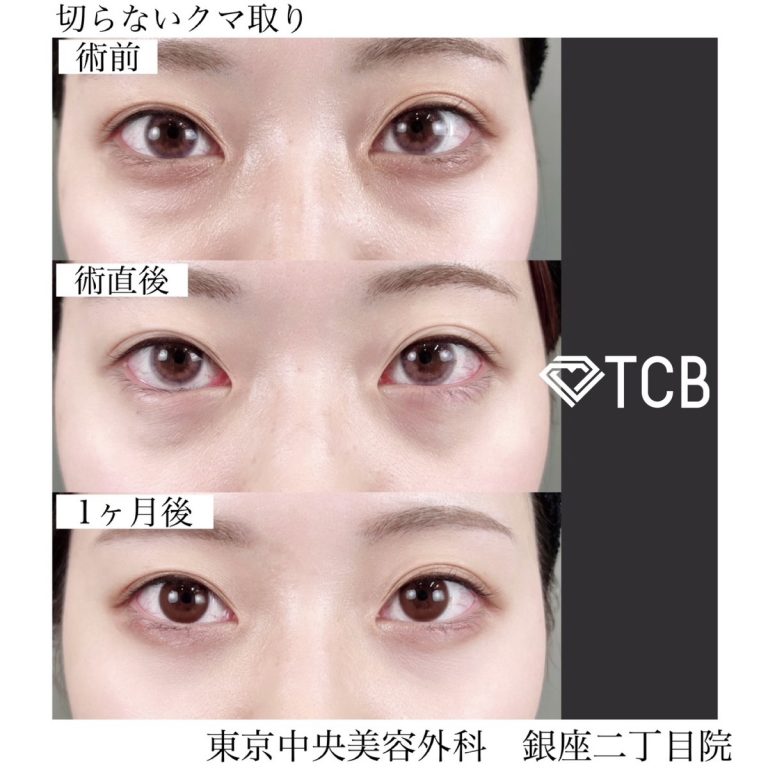 切らない目の下のクマ取り・目の下のたるみ（ふくらみ）取り(担当医:TCB 医師)の症例写真1