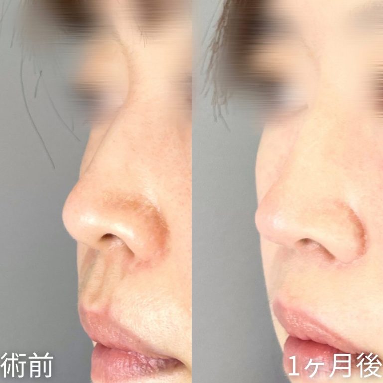 鼻尖形成(担当医:山内 崇史 医師)の症例写真2