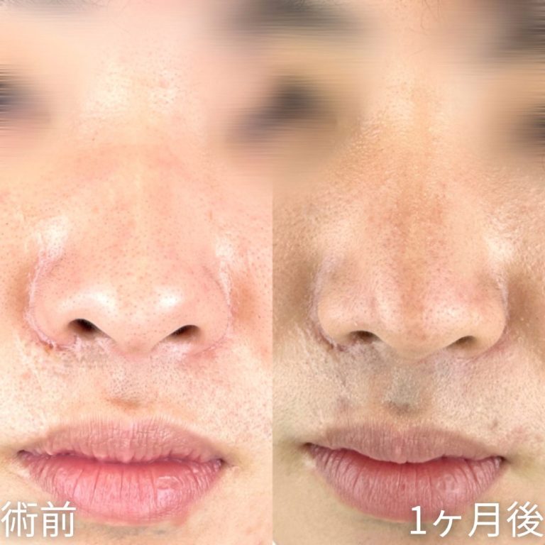 鼻尖形成(担当医:山内 崇史 医師)の症例写真1