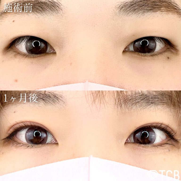 二重埋没法(担当医:TCB 医師)の症例写真1