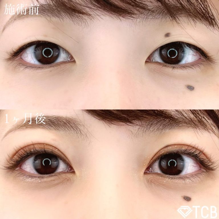 二重埋没法(担当医:TCB 医師)の症例写真1