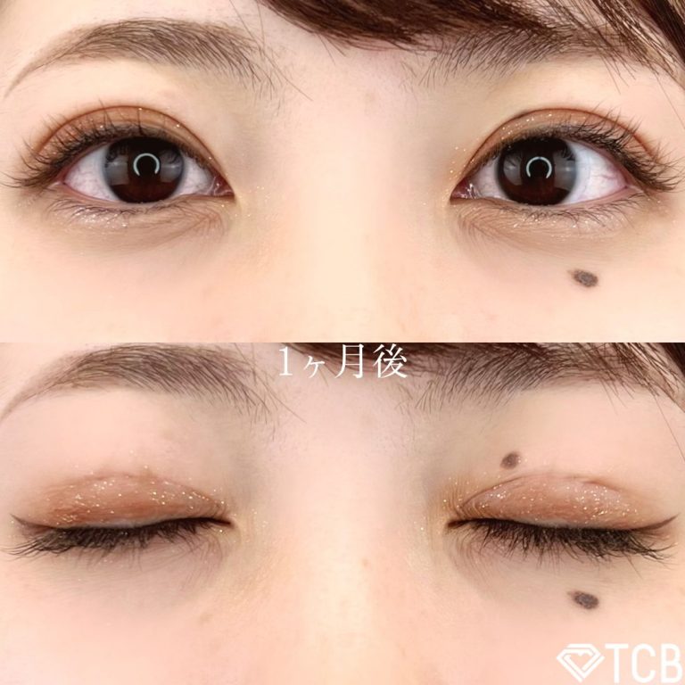 二重埋没法(担当医:TCB 医師)の症例写真2