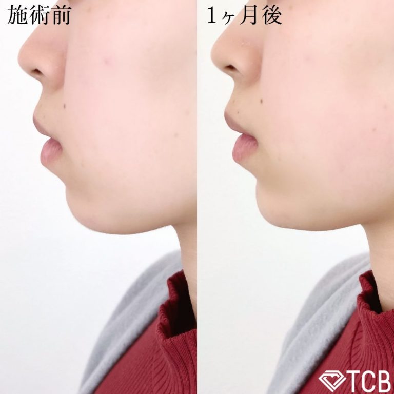 切らない顎形成 3D Eライン(担当医:TCB 医師)の症例写真1
