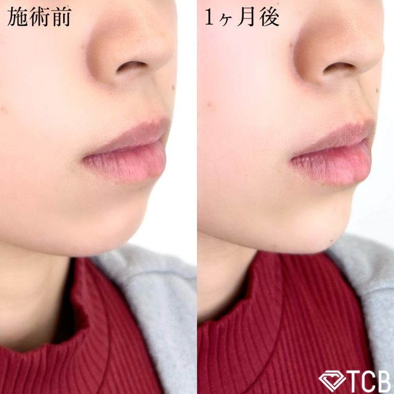 切らない顎形成 3D Eライン(担当医:TCB 医師)の症例写真2