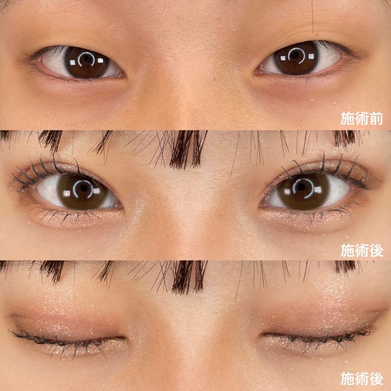 二重埋没法(担当医:TCB 医師)の症例写真1