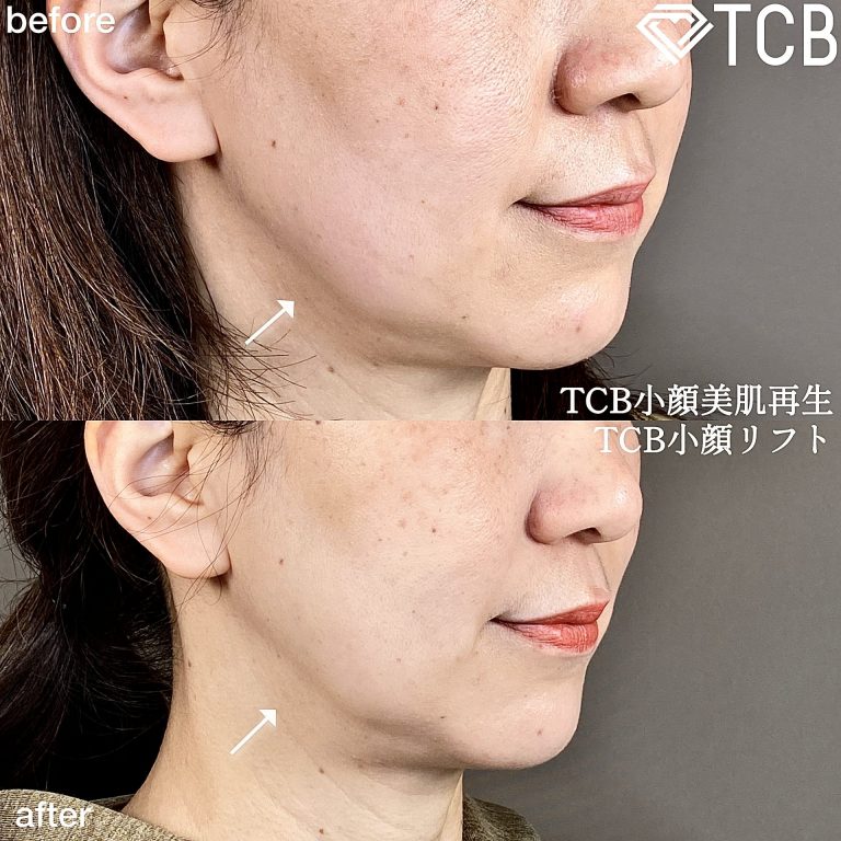 TCB式小顔美肌再生(担当医:森本 理一郎 医師)の症例写真2