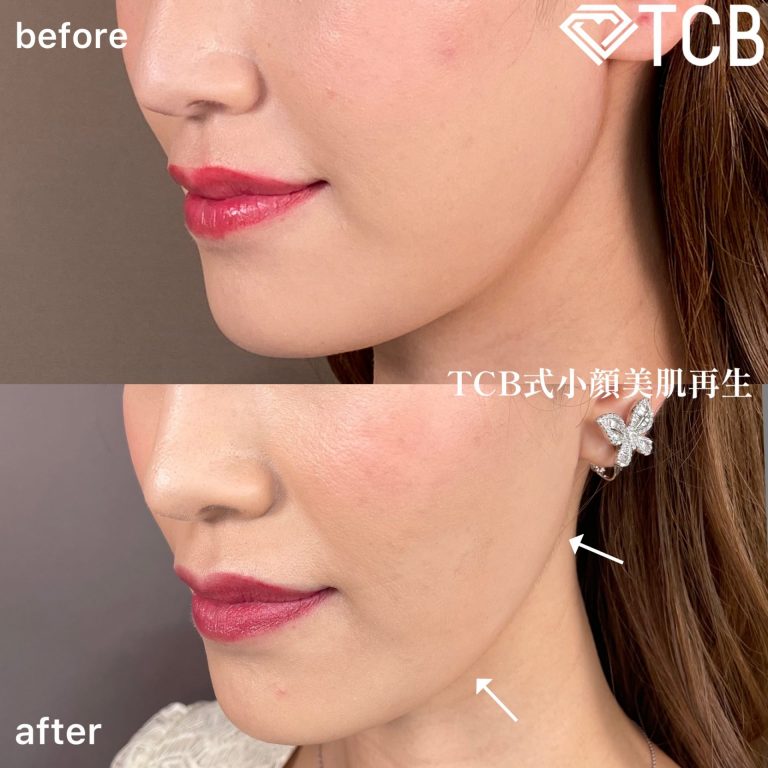 小顔美肌再生（リフトアップ）(担当医:TCB 医師)の症例写真2