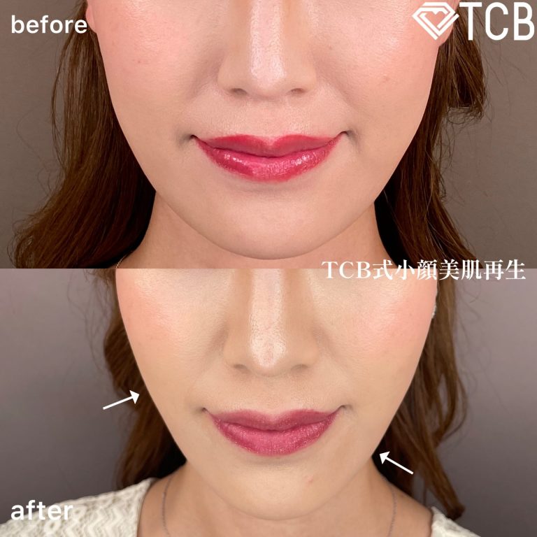 小顔美肌再生（リフトアップ）(担当医:TCB 医師)の症例写真1