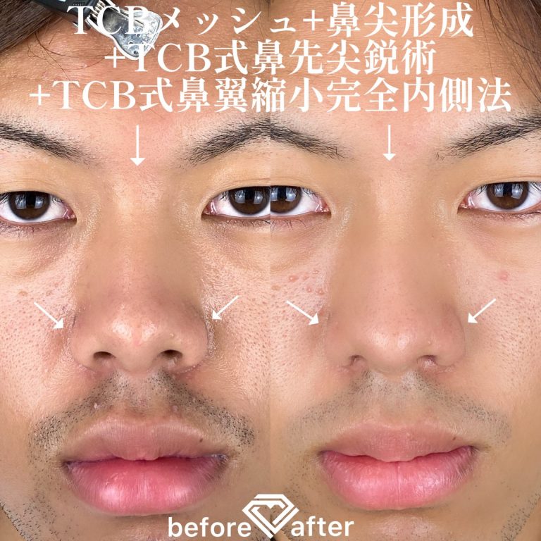 TCBメッシュ(担当医:TCB 医師)の症例写真1