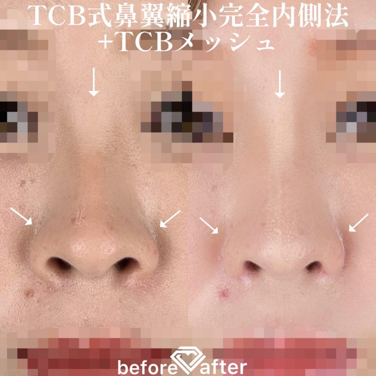 TCBメッシュ(担当医:TCB 医師)の症例写真1