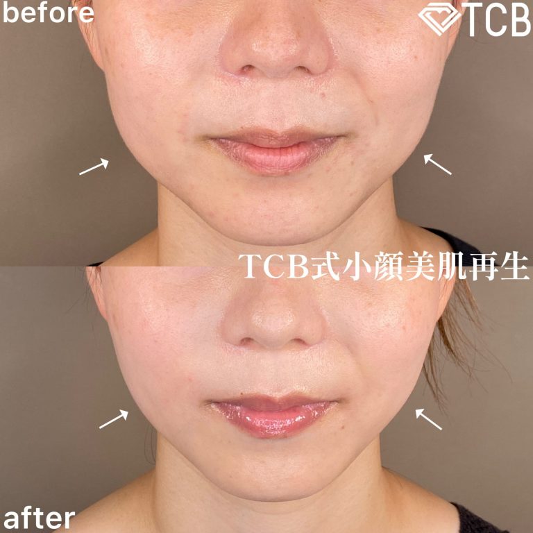 小顔美肌再生（リフトアップ）(担当医:TCB 医師)の症例写真1