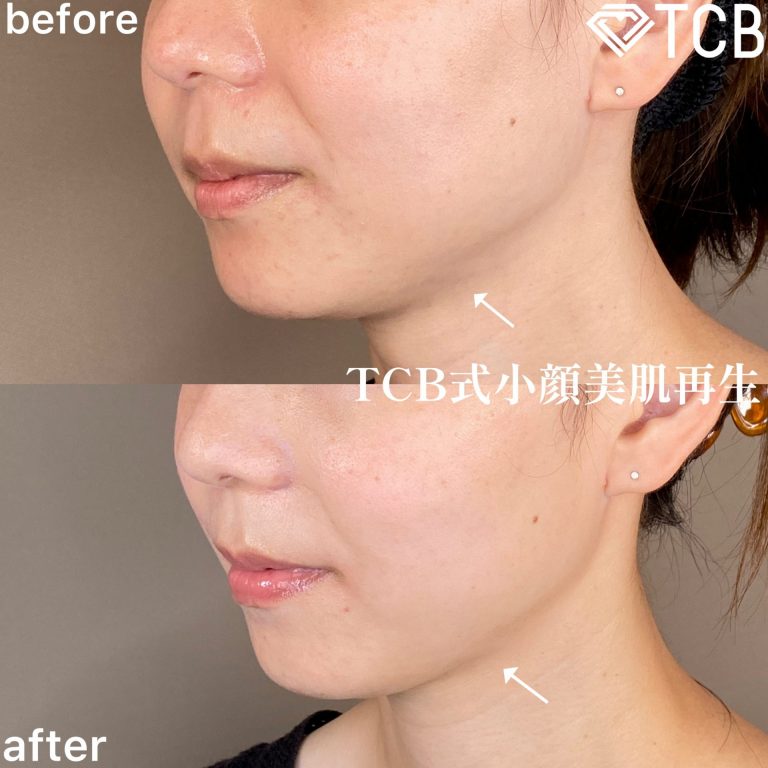 小顔美肌再生（リフトアップ）(担当医:TCB 医師)の症例写真2