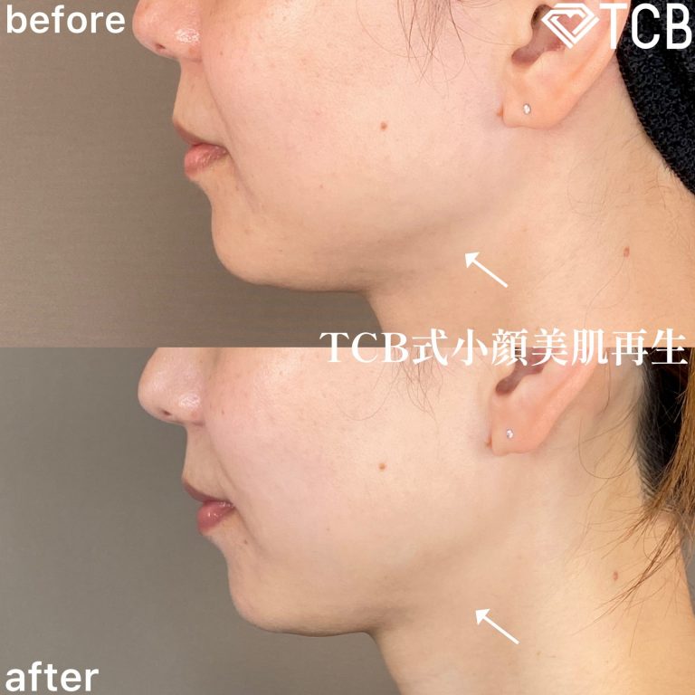小顔美肌再生（リフトアップ）(担当医:TCB 医師)の症例写真3