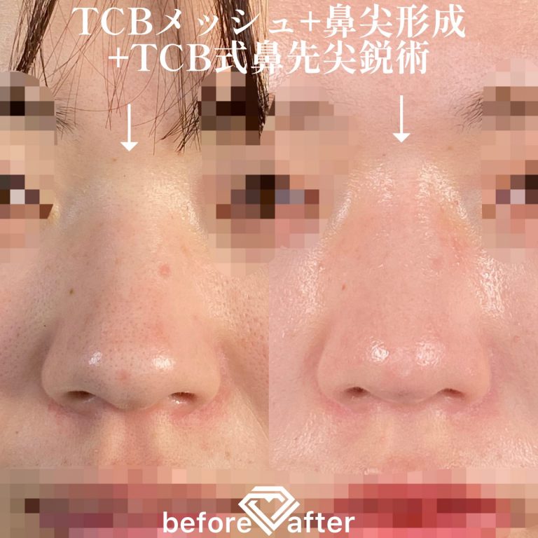 TCB式鼻先尖鋭術（だんご鼻解消）(担当医:TCB 医師)の症例写真1