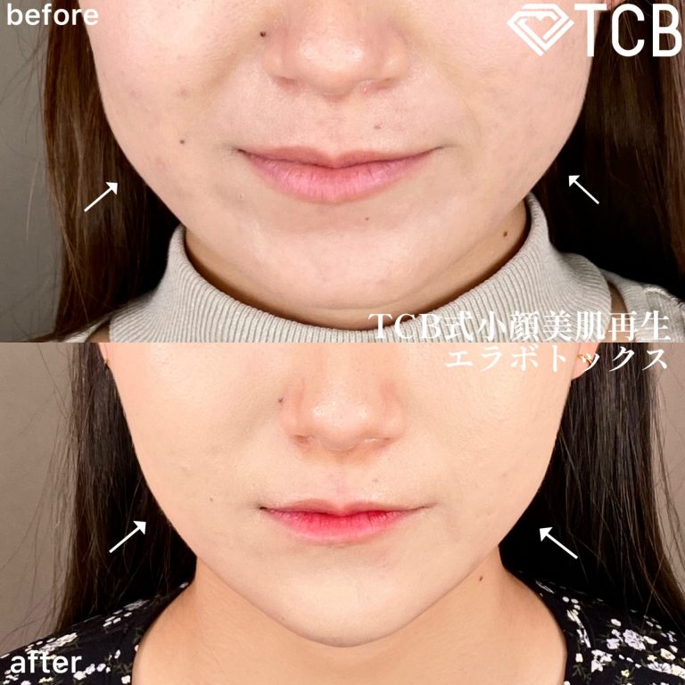 小顔美肌再生（リフトアップ）(担当医:TCB 医師)の症例写真1