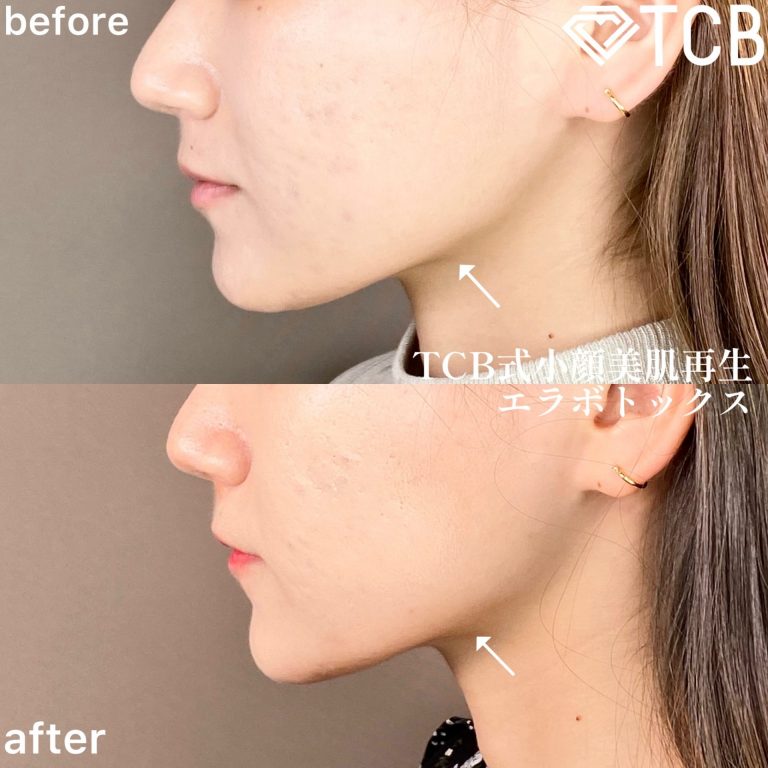 小顔美肌再生（リフトアップ）(担当医:TCB 医師)の症例写真3