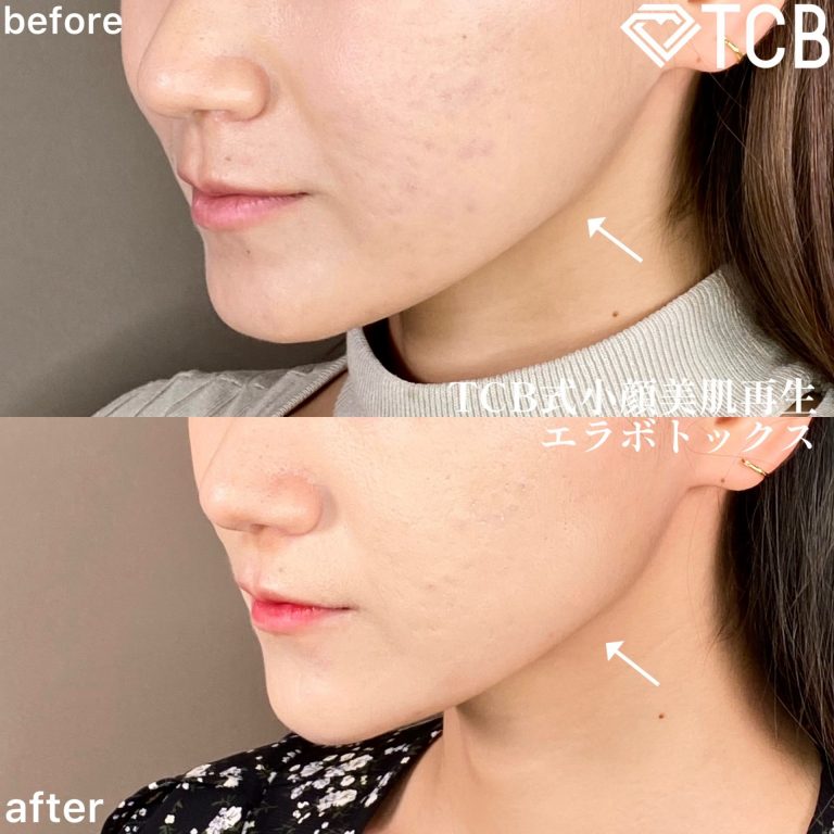 小顔美肌再生（リフトアップ）(担当医:TCB 医師)の症例写真2