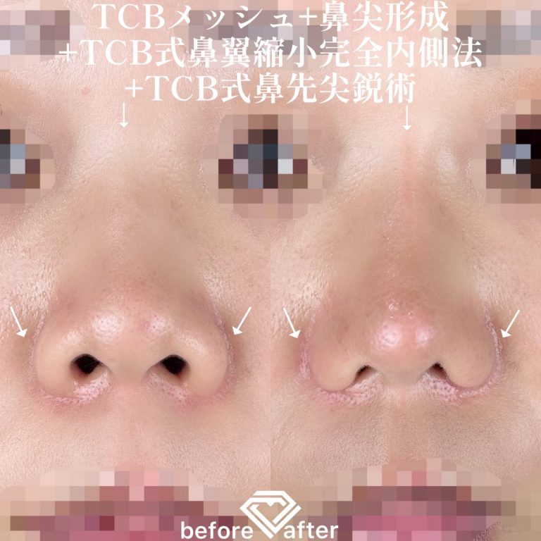 鼻尖形成(担当医:TCB 医師)の症例写真1