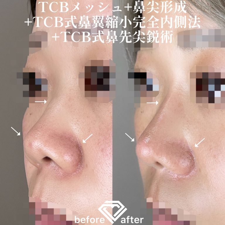 鼻尖形成(担当医:TCB 医師)の症例写真2