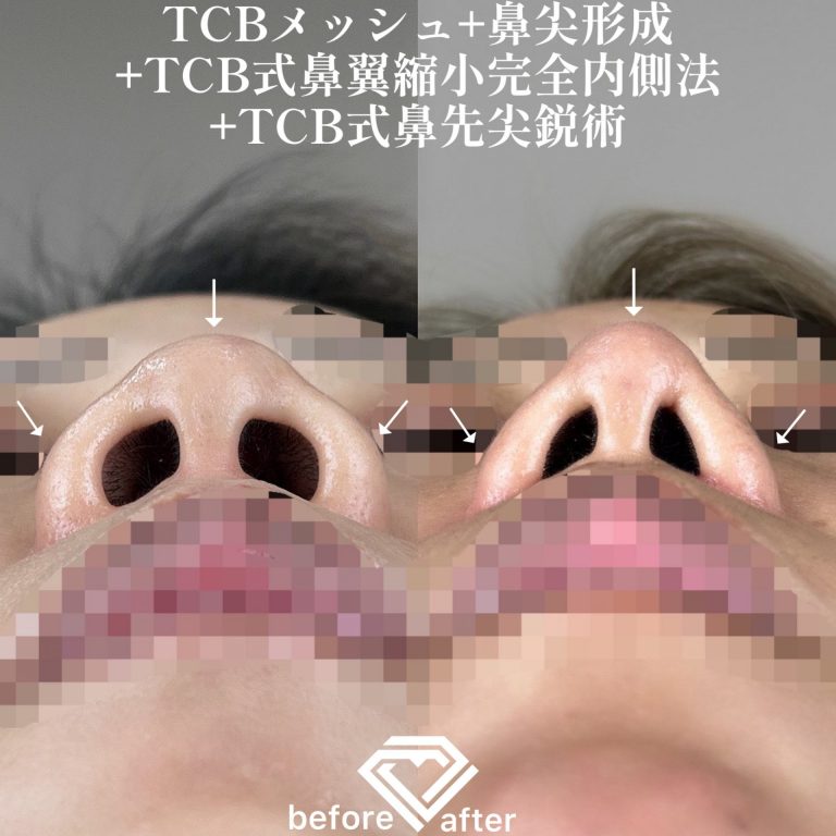 鼻尖形成(担当医:TCB 医師)の症例写真4