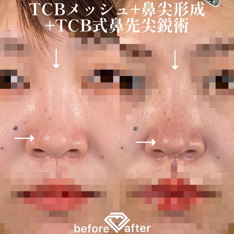 鼻尖形成(担当医:TCB 医師)の症例写真1