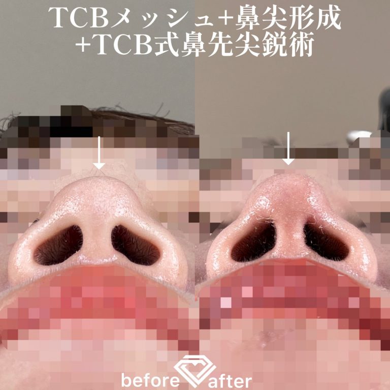 鼻尖形成(担当医:TCB 医師)の症例写真4