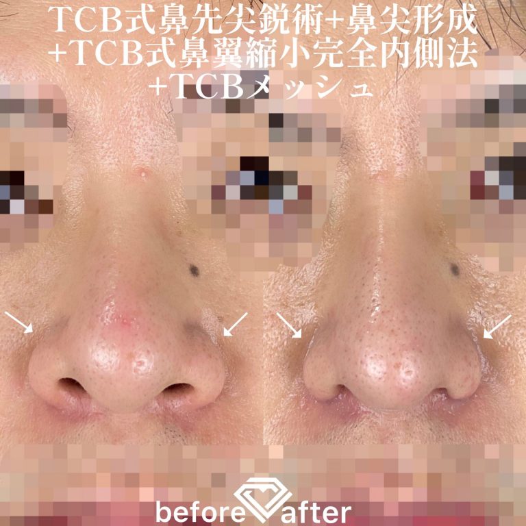 TCBメッシュ(担当医:TCB 医師)の症例写真1