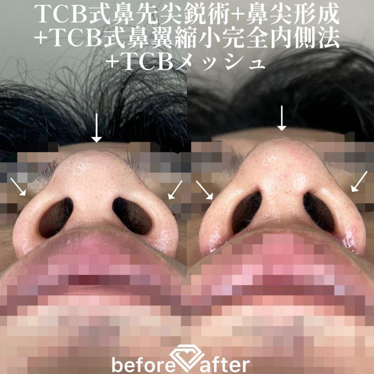 TCBメッシュ(担当医:森本 理一郎 医師)の症例写真2