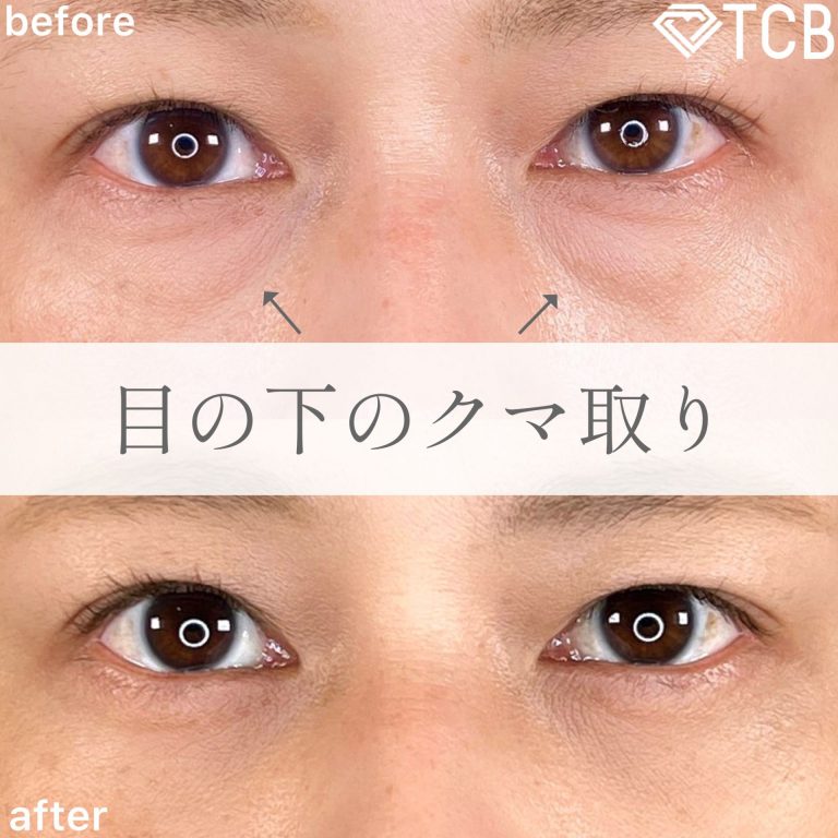 切らない目の下のクマ取り・目の下のたるみ（ふくらみ）取り(担当医:TCB 医師)の症例写真1