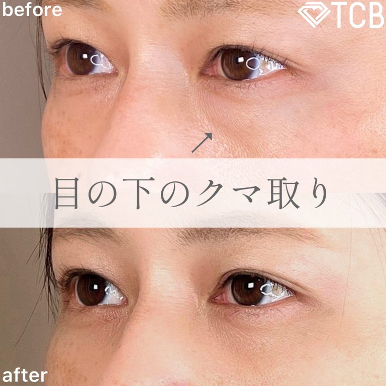 切らない目の下のクマ取り・目の下のたるみ（ふくらみ）取り(担当医:TCB 医師)の症例写真2