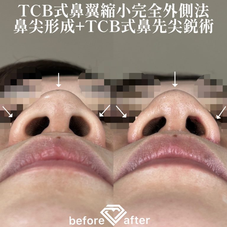 TCB式鼻先尖鋭術（だんご鼻解消）(担当医:森本 理一郎 医師)の症例写真2