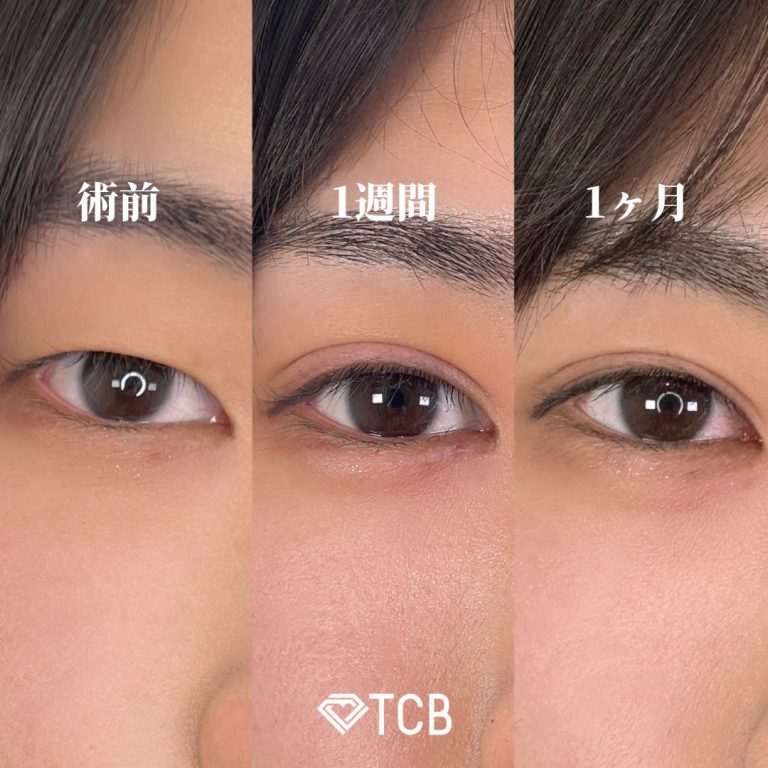 二重埋没法(担当医:TCB 医師)の症例写真1