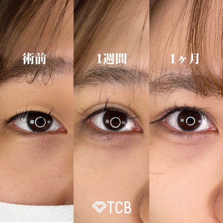 二重埋没法(担当医:TCB 医師)の症例写真1