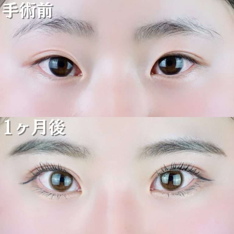 二重埋没法(担当医:TCB 医師)の症例写真1