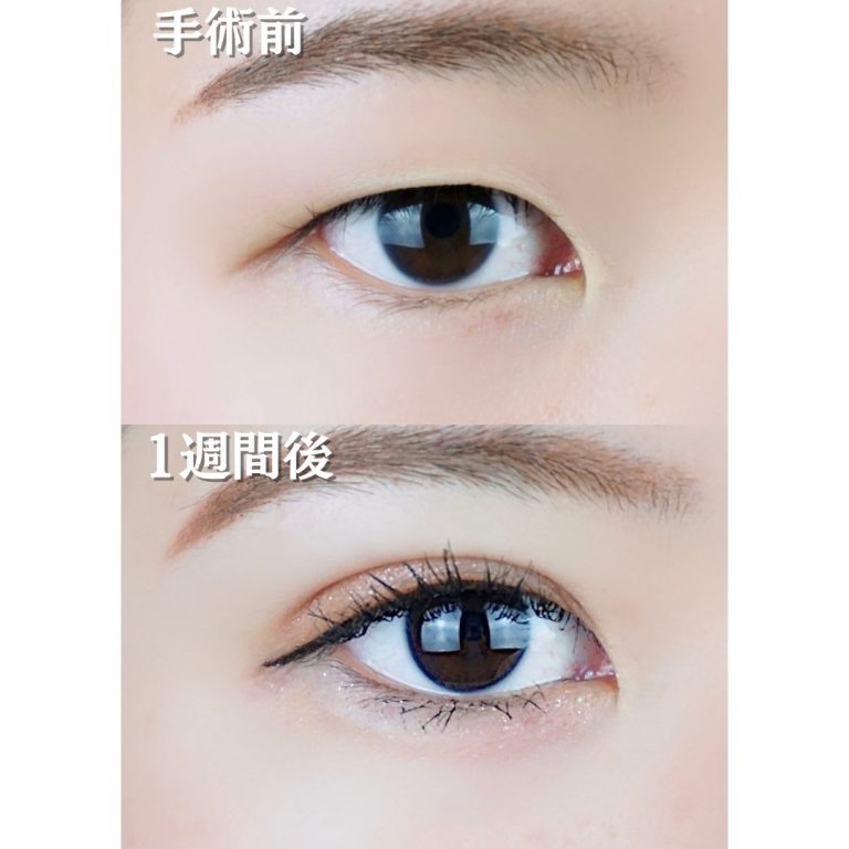 二重埋没法(担当医:TCB 医師)の症例写真1