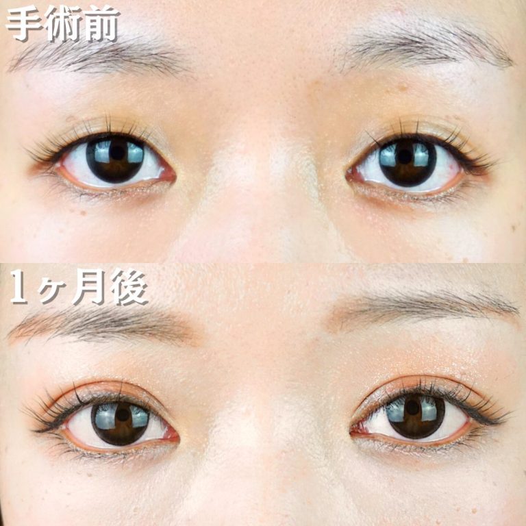 二重埋没法(担当医:TCB 医師)の症例写真1