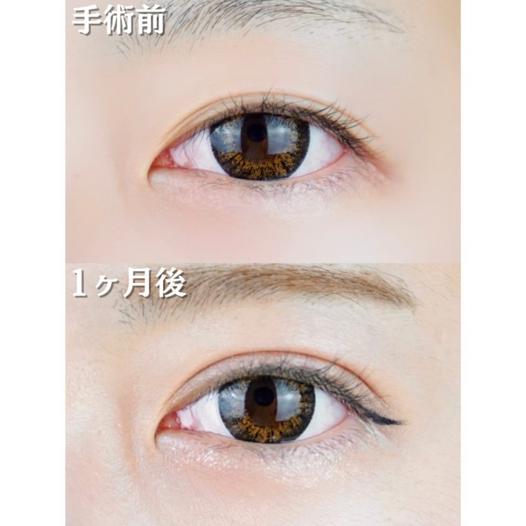 二重埋没法(担当医:TCB 医師)の症例写真1