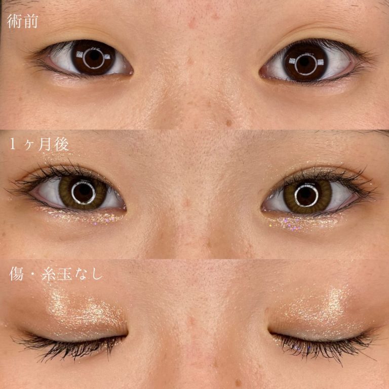 二重埋没法(担当医:TCB 医師)の症例写真1