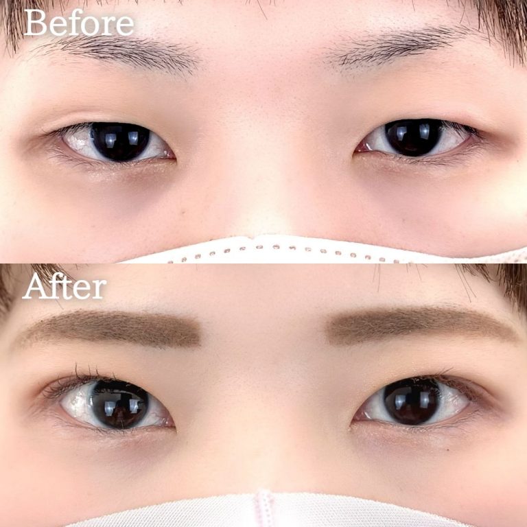 二重埋没法(担当医:TCB 医師)の症例写真1