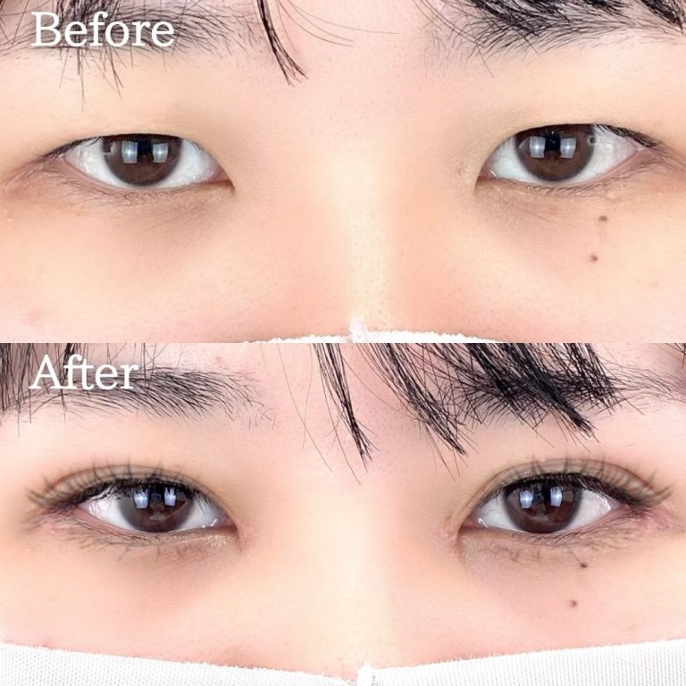 二重埋没法(担当医:TCB 医師)の症例写真1