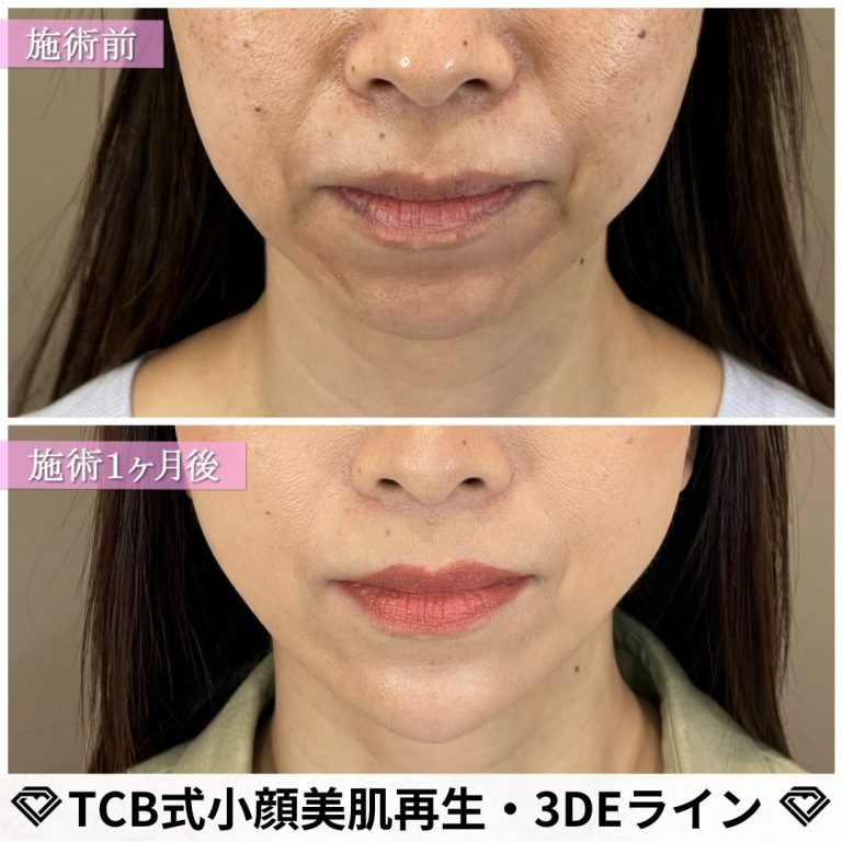 TCB式小顔美肌再生(担当医:岡村 尚泰 医師)の症例写真1
