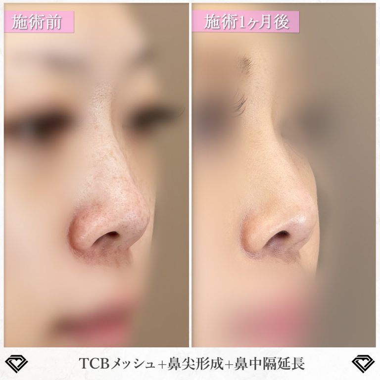 鼻尖形成(担当医:篠永 宏行 医師)の症例写真1