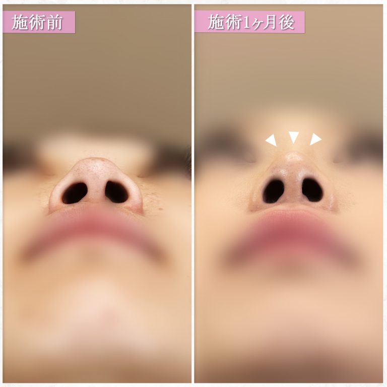 鼻尖形成(担当医:篠永 宏行 医師)の症例写真3